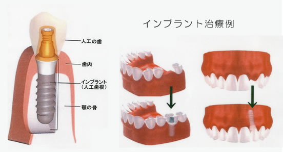 インプラント治療例